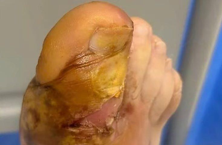 Wolf spider lays eggs in man's toe