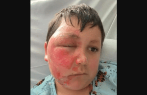 TikTok Trend Leads to Severe Burns for 9-Year-Old Boy